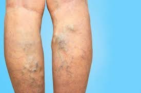 Vericose Vein